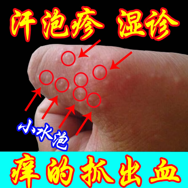 汗状疱疹脱皮手水泡湿疹止痒去皮肤瘙痒止痒抑菌顽固藓皮炎过敏根