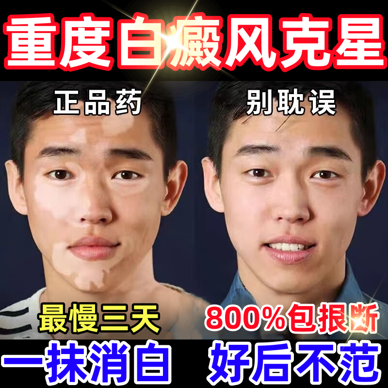 白癜特风药效专用补骨脂酊促进黑色素生长外用快速消白斑进口膏药