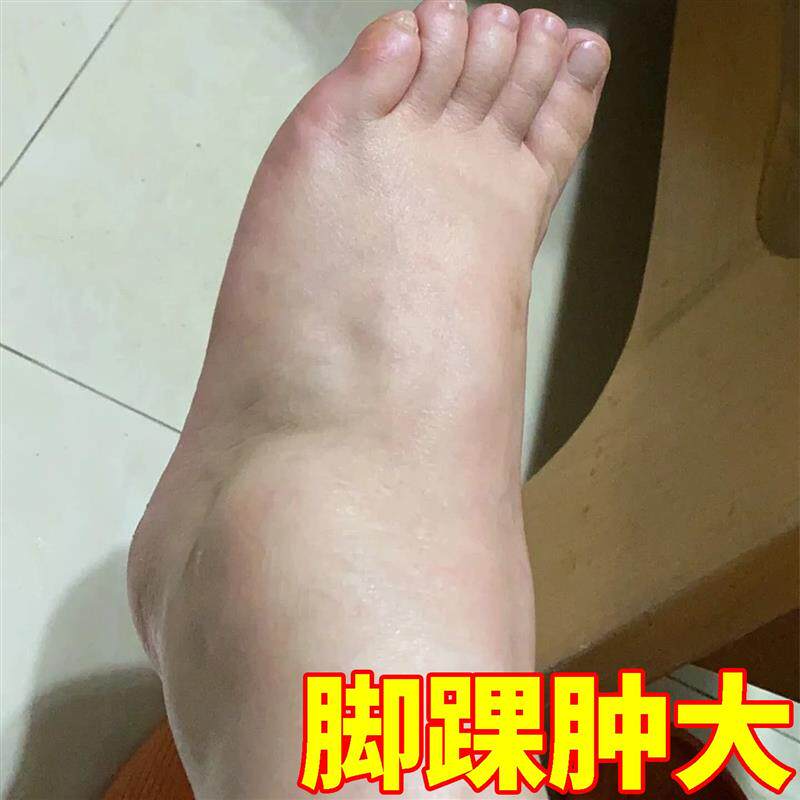 脚踝受伤崴脚走路神器扭伤脚踝热敷脚腕韧带拉伤恢复专用药贴