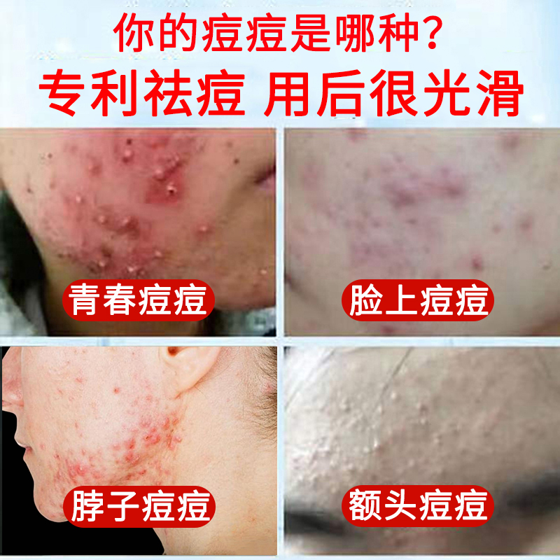 青春期痘痘祛痘男孩脸上长痘痘擦什么女孩额头痘痘脖子上面长痘痘
