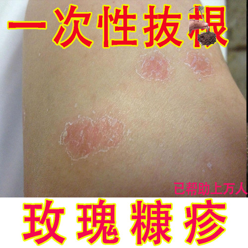 玫瑰糠疹荨麻专用膏白色糠长白斑铜钱藓膏止痒膏