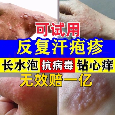 小水泡患者福音！已治愈万人药膏