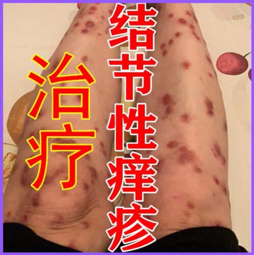 结节性痒疹特效药膏 组合 特效 组合 特效