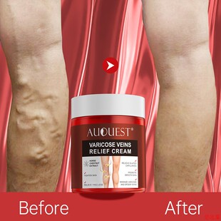 Varicose Ve Relief Cream Vasculitis Phlebitis Spider Pain Re