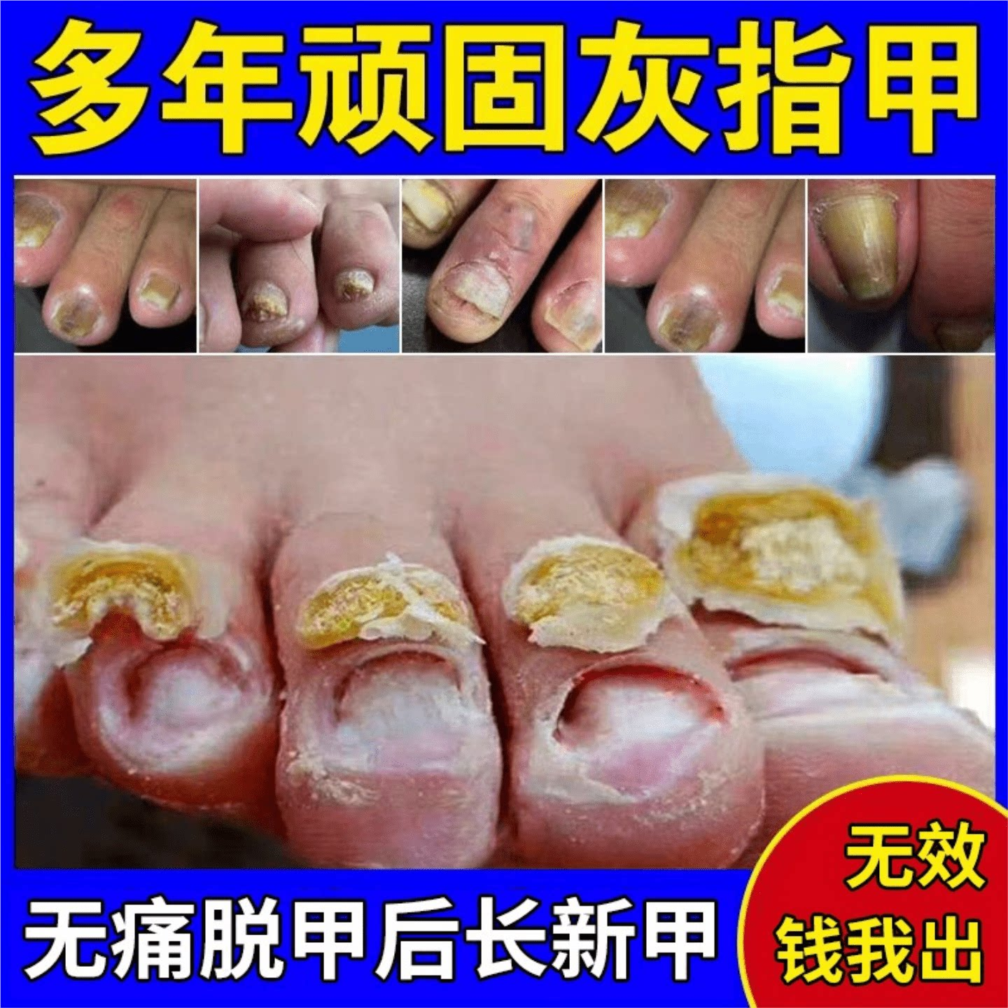 脱甲膏灰指甲专用抑菌液去甲沟炎快速无痛脱甲精油灰趾指甲软化膏