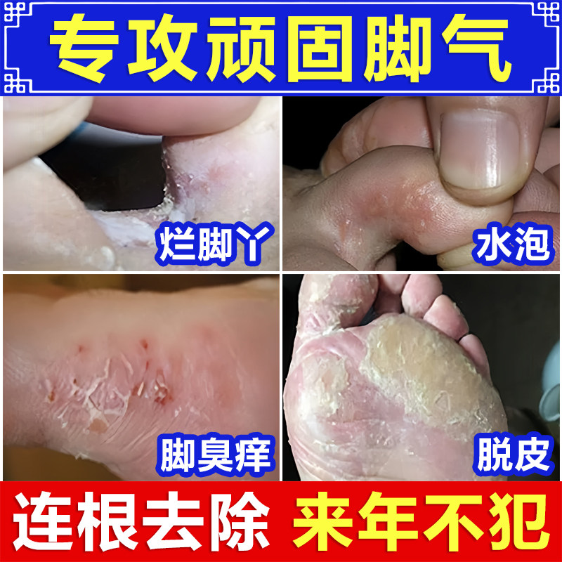 治臭气脚喷雾除脚酸臭味根用药专去真菌止汗神器特防脚出汗克星效