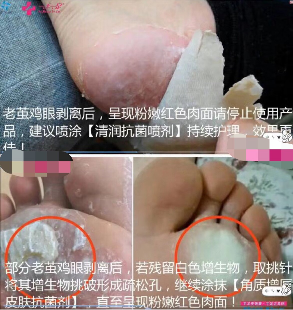 发新包装【成膜抗菌剂】 脚垫脚茧脚底厚脚趾关节茧子 角质增厚
