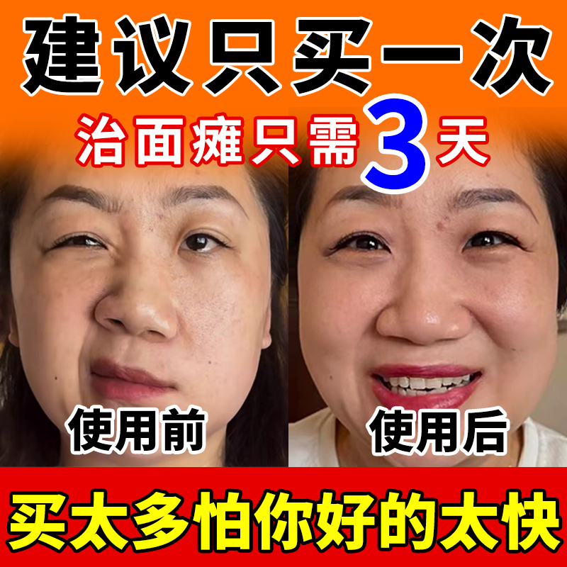 【一贴牵正告别面瘫】面瘫贴