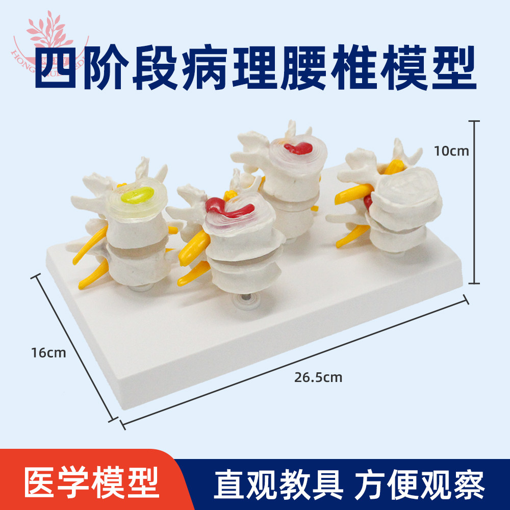 4阶段病变腰椎模型店长荐医用教学展示腰椎腰椎间盘突出病理腰椎