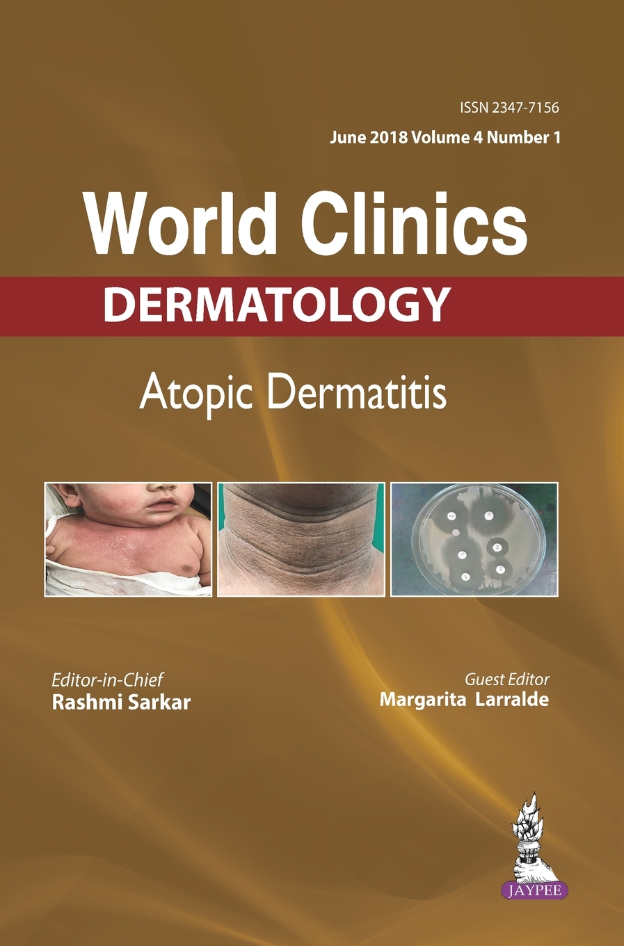 【预售按需印刷】WORLD CLINICS-ATOPIC DERMATITIS(JUNE 2018 VOL.04 ISSUE 1)