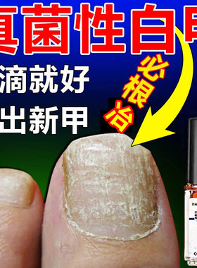 【不用拔甲】真菌性白甲脚趾甲变厚发黄发白灰指甲甲床分离修复药
