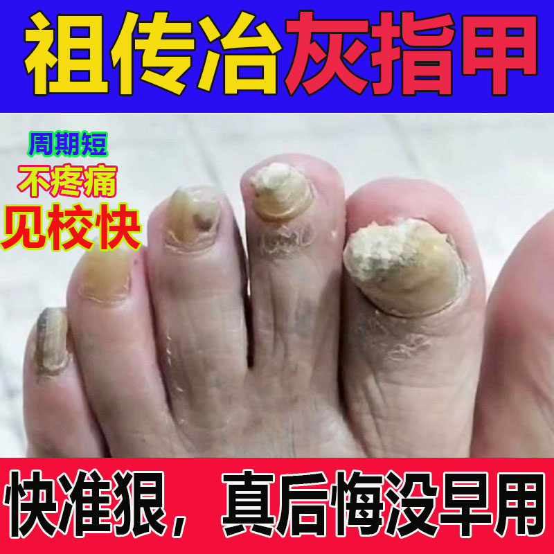 灰指甲脚趾甲变厚发黄真菌性白甲盖正品甲床分离空甲修复液
