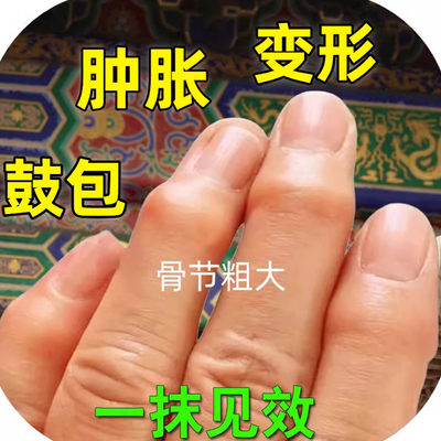 类风湿性关节炎手指关节变形肿大粗大神器僵硬增生疼痛酸麻专用药