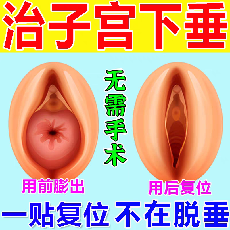 妇女中老年专用产后咳嗽漏尿贴治疗提升产后子宫颈脱垂的中药贴膏