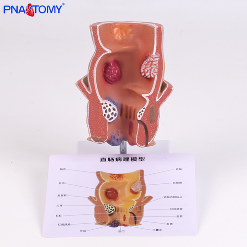 PNATOMY直肠痔疮病变病理模型