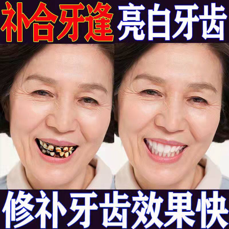 牙缝宽大修复神器自补贴面牙缝神器牙齿贴片门牙牙缝贴牙齿填充物