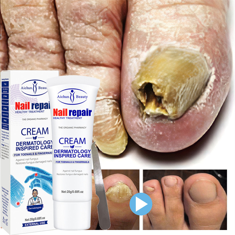 Effective Nail Fungus Treatment Cream Foot Toe Nail Fungus R