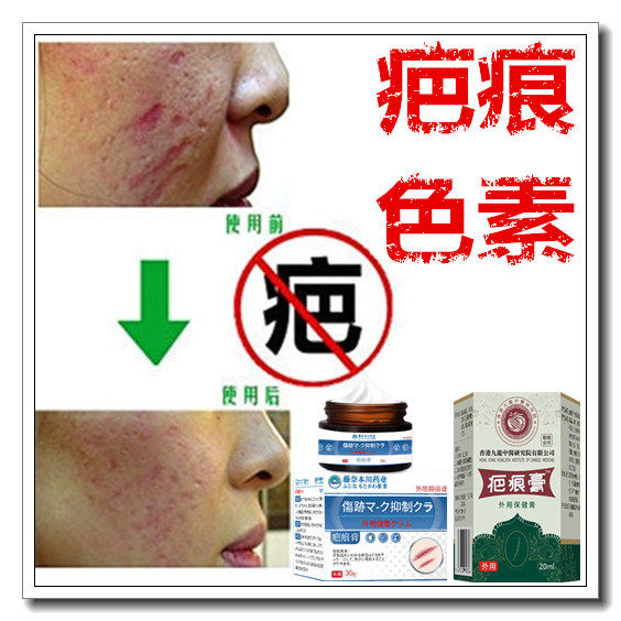 草本祛黑色素沉着回流色素印痕霜淡化抓痕黑印红印产品正品药膏贴