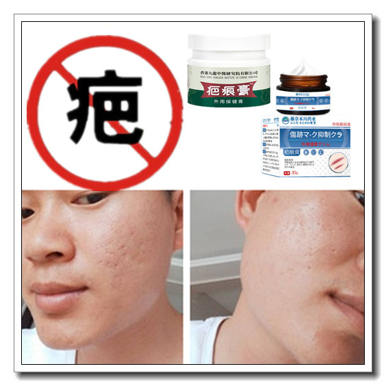 正品男女烧伤药用烟烫去除凹凸增生性体质疤痕印软化疙瘩黑色素膏