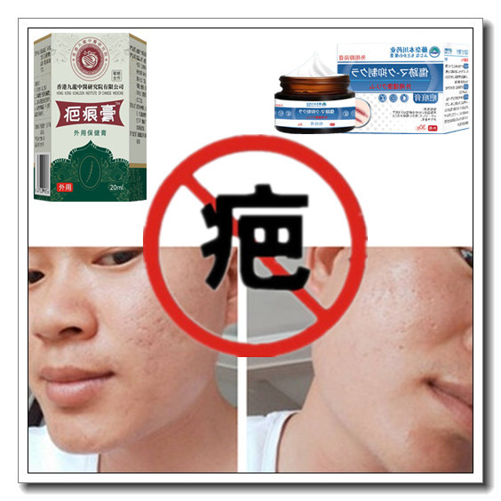 除男女烧伤药正品消去增生性凹凸巴软化疙瘩烟烫疤痕印黑色素产品