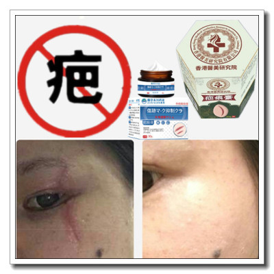 手术修复药膏增生性突疤疙瘩破腹产伤疤痕印灵烟疤缝针沉着色素液