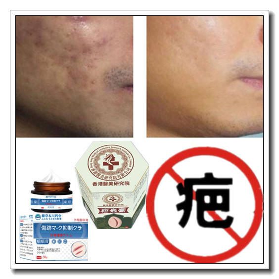 消去烟烫疙瘩祛除烧伤药液软化增生性凹凸烟疤痕印黑色素沉着产品
