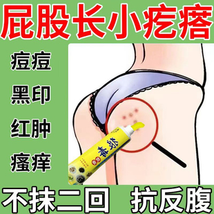 屁股上长疙瘩起痘痘久坐痒膏湿痒拔毒热毒红疙瘩私处膏