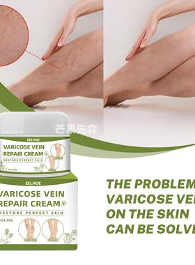 Varicose vein cream leg swelling care cream静脉按摩曲张膏