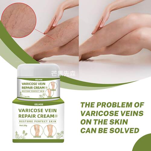 Varicose vein cream leg swelling care cream静脉按摩曲张膏