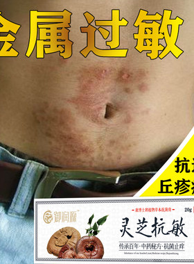 金属过敏皮肤瘙痒止痒膏