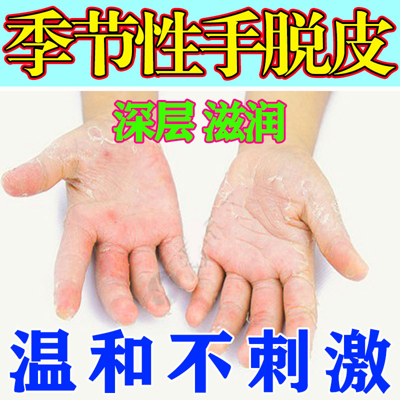 手足脱皮膏手指上起皮干燥爆皮儿童手掌蜕皮手心手脚掉皮儿童专用