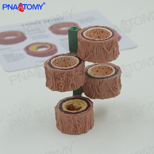 四阶段动脉血管模型粥样化演示教具血管硬化解剖展示模具