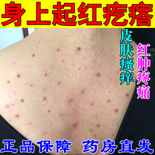 身上长痘痘前胸后背头上起红疙瘩痒后背皮肤痒除螨外用抑菌止痒膏
