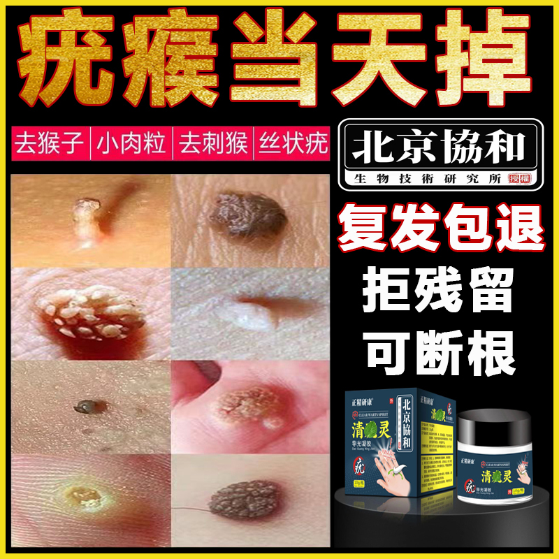 刺猴去除正品去猴子小肉粒疙瘩灵药祛尤疣瘊子神器一抹无忧肉刺膏