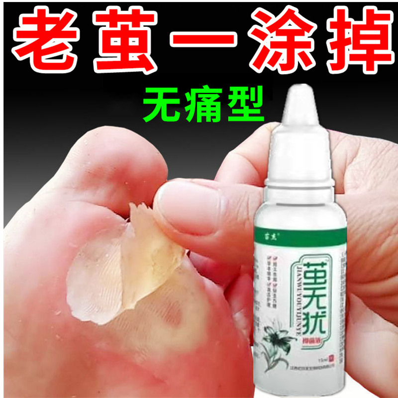 滴茧去老茧脚茧根神器软化剂脚掌去除死皮膏硬皮脚底脚垫手茧子脚