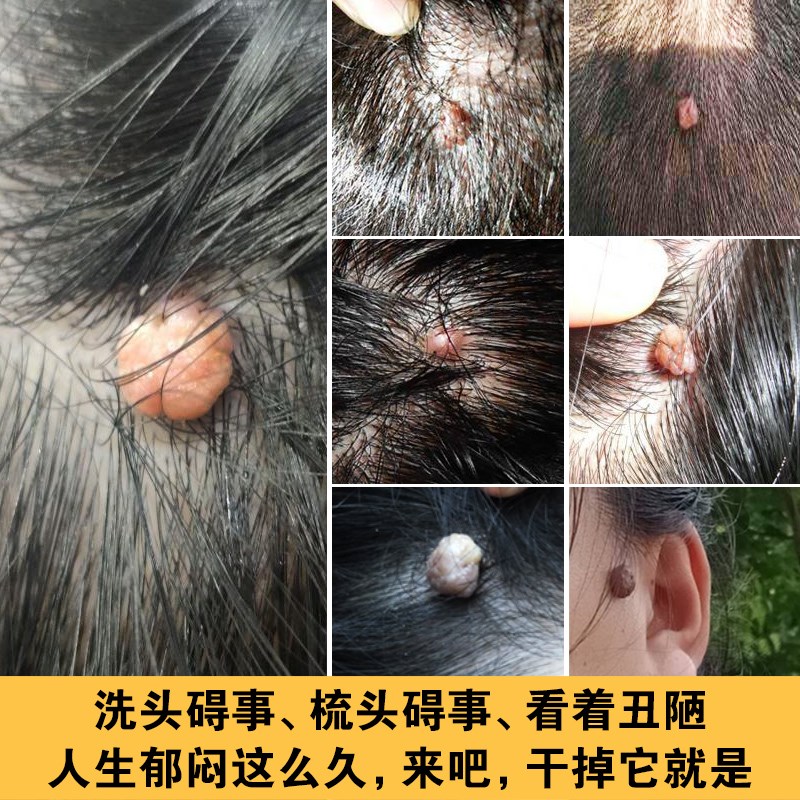 专点头上大痦子肉球头上肉痣 去头上痦子肉疙瘩大肉粒祛除瘊子猴