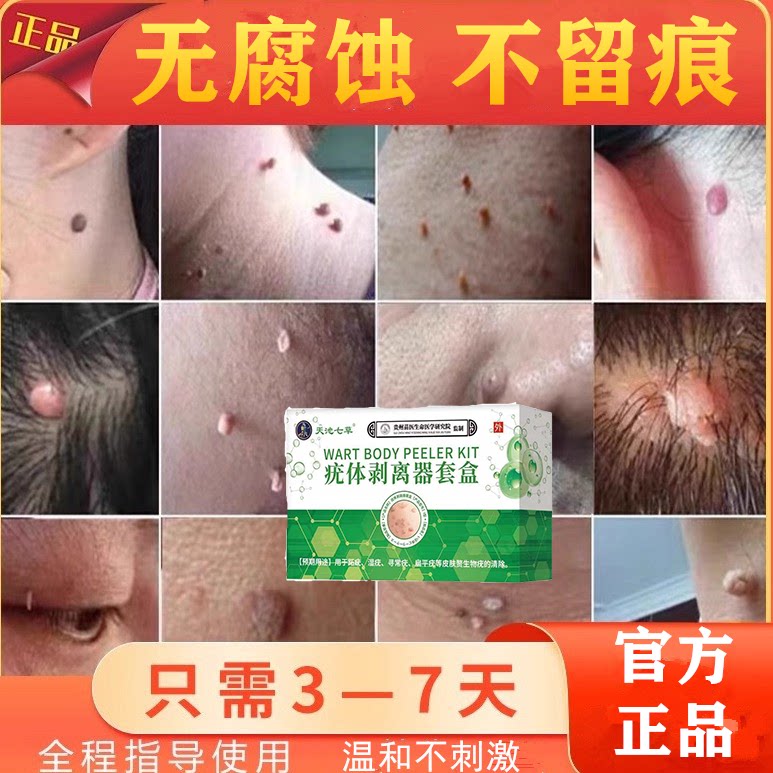 脖子上长小肉粒疙瘩面部腋下丝状疣去除神器祛瘊子点猴子药去皮赘