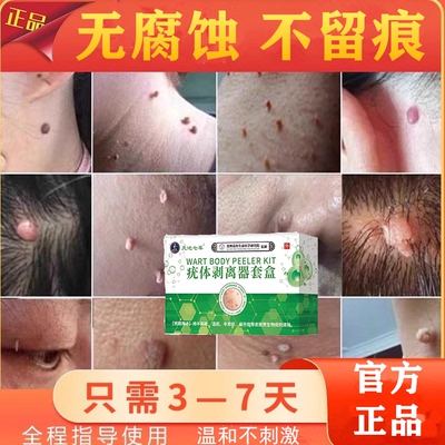 尖锐疣湿疣扁平疣去除膏丝状疣跖疣男性女性私处HPV中药.膏肛周疣