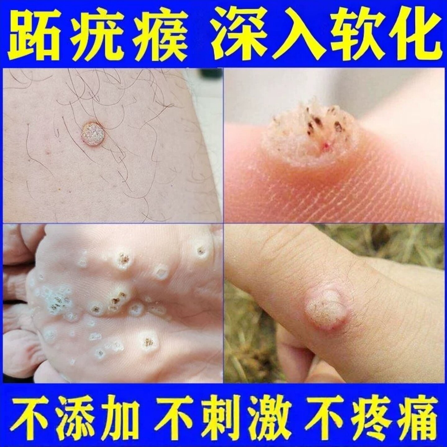 去鸡眼跖疣专用膏足部肉刺瘊子疙瘩去除贴脚底甲周寻常疣立净正品