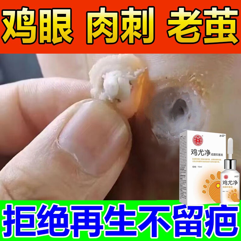 鸡眼膏贴脚鸡贴眼跖疣去除膏寻常疣去脖子上长小肉粒尤瘊药水神器