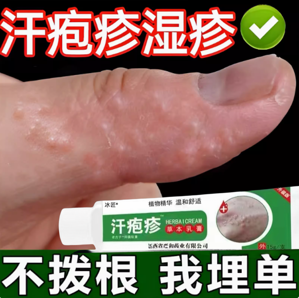汗疱疹去手上起小水泡汉汗状真菌感染专用软膏干裂脱皮痒根