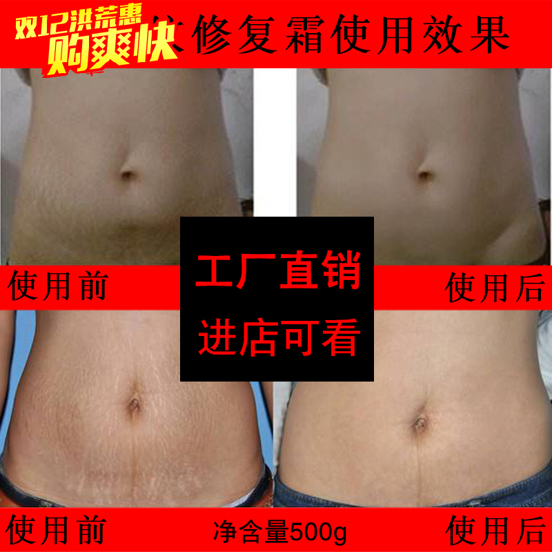[药妆工厂直销店身体乳,霜]孕妇预防妊娠纹修复乳霜产前产后强效淡月销量0件仅售1360元