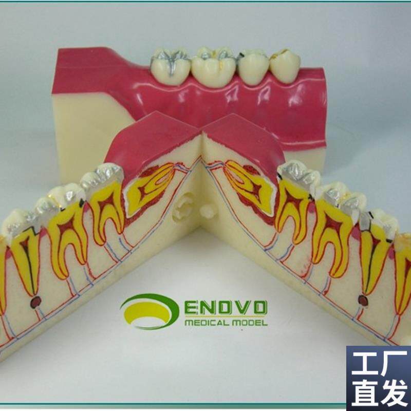 ENOVO颐诺右下后牙r组织分解模型牙齿解剖牙列模型口腔齿科科教学