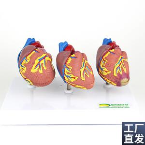 ENOVO颐诺心脏l病演示模型心血管系统心肌梗死充血性心力衰竭心