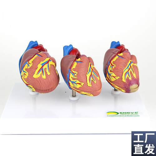 ENOVO颐诺心脏l病演示模型心血管系统心肌梗死充血性心力衰竭心
