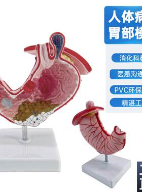 人体胃解剖模型放大胃结s构胃镜教学病理胃解剖模型病态胃模型