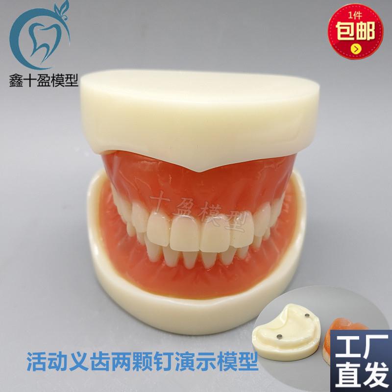 牙科模型活动义齿牙模讲解模型全口义齿两颗N钉教学模型T21包邮