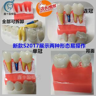 牙科4倍种植解i模型义齿修复种植牙解说展示可拆卸连桥牙冠种植钉