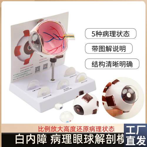 白内障眼球病变模型青光眼眼球结D构模型医患教学解剖展示模型