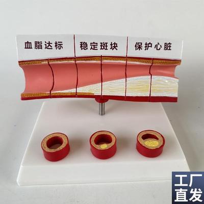 血管/堵塞动支脉粥样/硬化心血管动脉/硬L化模型血管病理模型血栓